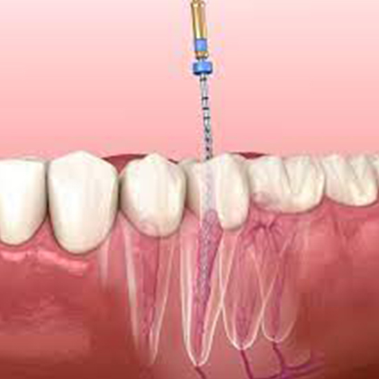 root-canal-treatment